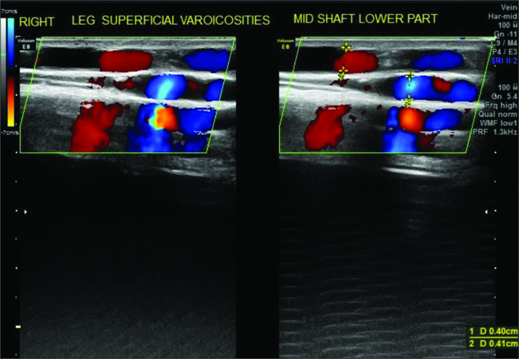 Color Doppler right leg showing varices in shaft region and incompetent perforator.