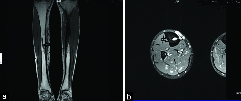 (a) Magnetic resonance imaging (MRI) leg showing complete tract of intratibial dilated perforator including its entry and exit point as well as external varices. (b) MRI leg showing complete tract of intratibial perforating vein including its entry and exit point as well as external varices.