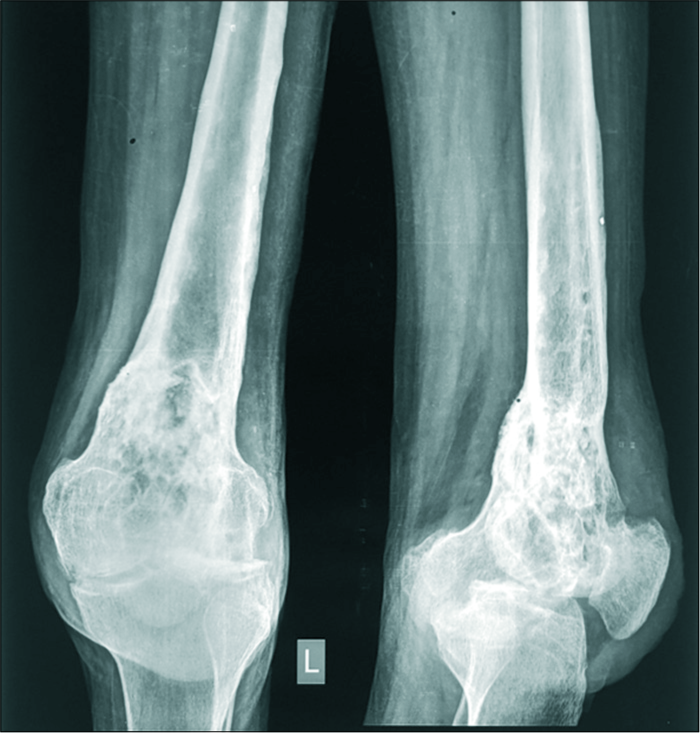 X-ray depicting changes like marked joint space narrowing, extensive destruction due to septic arthritis.
