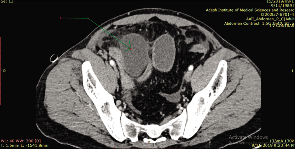 Contrast-enhanced computed tomography abdomen – axial reformation showing Meckel’s diverticulum (arrow) with imperceptible bowel wall.