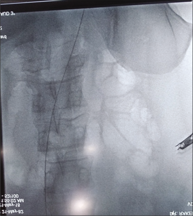 The guidewire migrated into thorax.