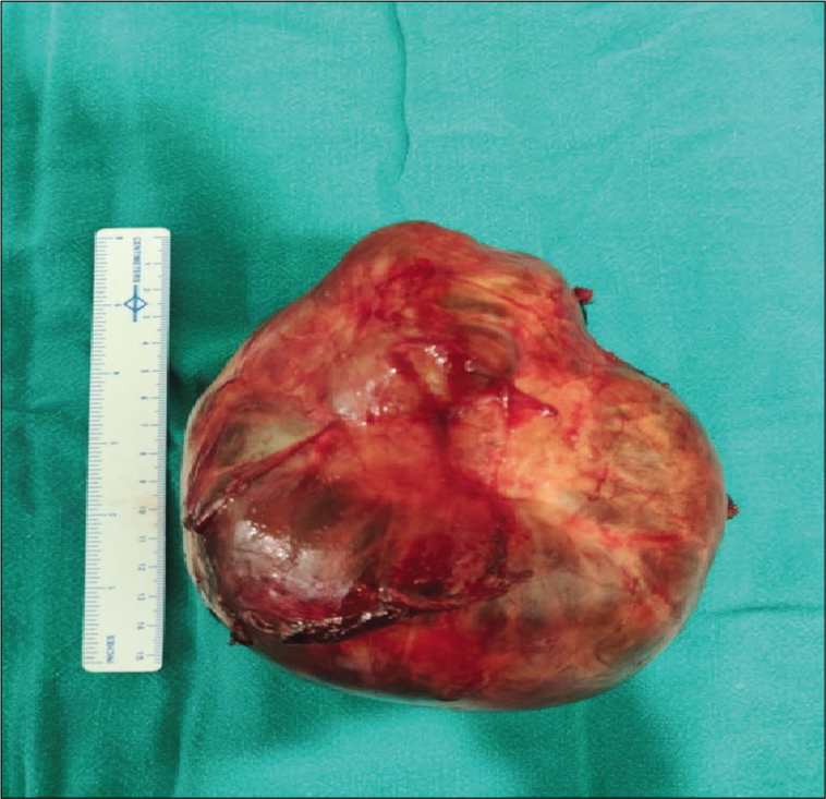 Specimen after thyroidectomy.