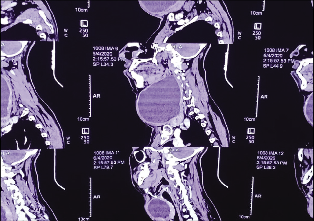 Contrast-enhanced computed tomography neck.