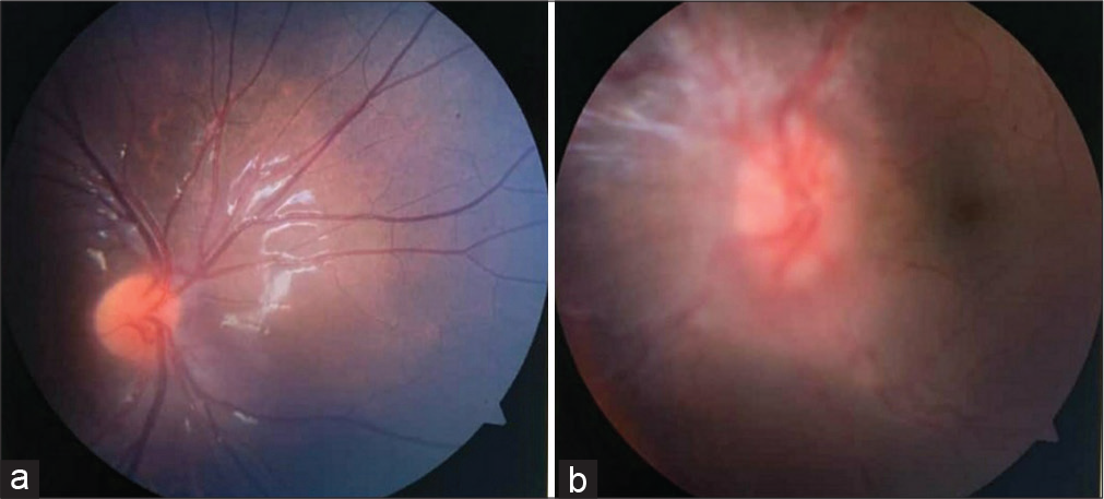 (a and b) Fundus of the right eye showed slightly tilted disc. The left eye showed extensive disc edema and adjacent retinal nerve fiber layer edema.