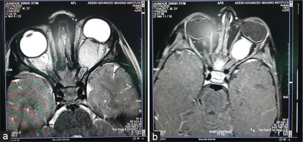 (a and b) Magnetic resonance imaging brain and orbit showed well-defined homogenously enhancing fusiform mass involving intraorbital segment of the left optic nerve extending from the level of optic disc causing proptosis of the left eyeball with no extension into the optic canal. The mass measured 2.1 cm × 1.5 cm × 1.7 cm (AP × T × CC). Flattening of posterior aspect of eyeball was seen with subtle edema in the region of optic disc. Optic canal and optic chiasm were normal. Extra-axial spaces and extraocular muscles of the left eye were normal