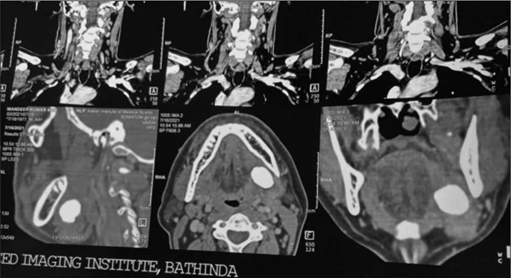 CT scan showing stone.