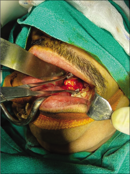 Intraoperative delivery of stone through intraoral approach.