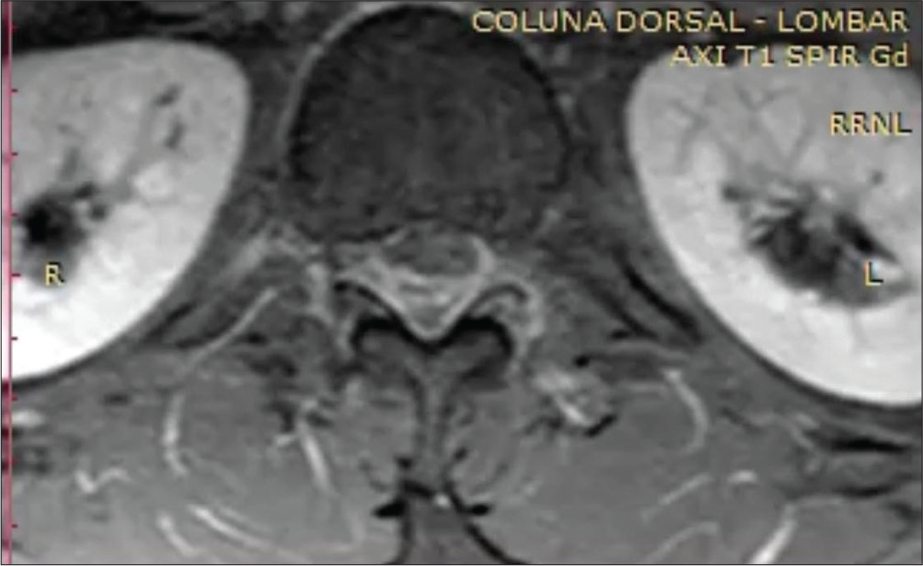 A 35-year-old man male with an extradural hematoma in thoracic spine with abdominal pain and fever. Axial image of an MRI of the thoracic spine, T1-weighted.