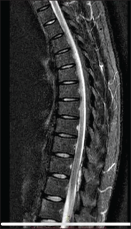 A 35-year-old man male with an extradural hematoma in thoracic spine with abdominal pain and fever. Sagittal MRI of the thoracic spine, T1-weighted.