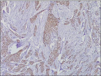 Photomicrograph of invasive carcinoma no special type, showing progesterone receptor-positive reaction (Original magnification ×40).