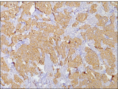 Photomicrograph of invasive ductal carcinoma showing Her-2+++ (Original magnification ×40).