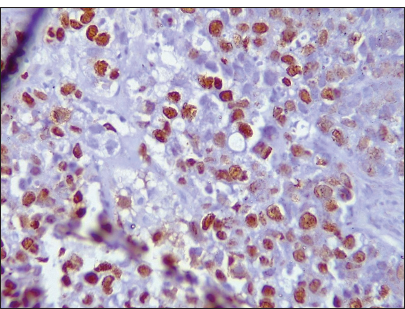 Photomicrograph of invasive breast carcinoma no special type showing ki67 nuclear reactivity (Original magnification ×100).