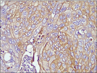 Photomicrograph of invasive breast carcinoma no special type showing epidermal growth factor receptor membrane reactivity (Original magnification ×100).