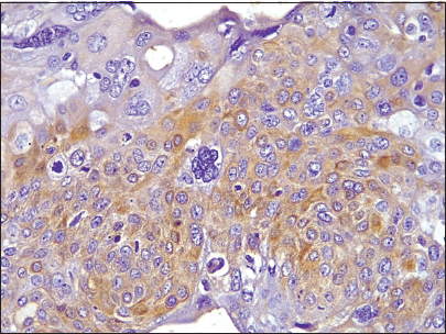 Photomicrograph of invasive breast carcinoma no special type showing CK5/6 cytoplasmic reactivity (Original magnification ×100).