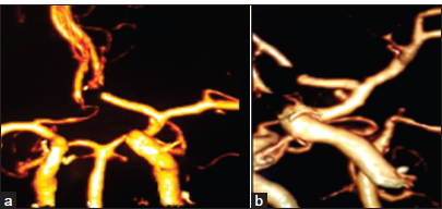 (a) Post-operative anterior view of computed tomography angiogram (CTA) shows complete clipping of the anterior communicating artery aneurysm with preservation of A2 segments bilaterally and no aneurysmal remnants and, a small anteriorly projecting pseudoaneurysm arising from the anterior wall of the pre-bifurcation internal carotid artery (ICA). (b) Post-operative left lateral view of CTA affirms the surgical clipping of the aneurysm and the presence of a small anteriorly-projecting pseudoaneurysm arising from the anterior wall of the pre-bifurcation ICA.