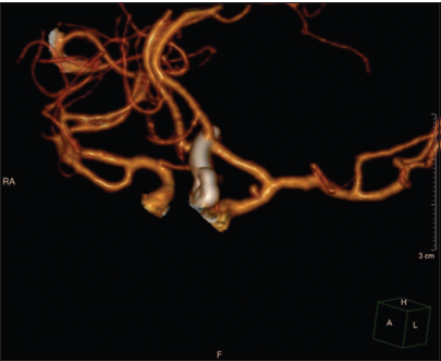 Follow-up computed tomography angiogram 1 month after the second surgery showing complete clipping of the anterior communicating artery aneurysm as well as persistence of the internal carotid artery pseudoaneurysm without any change in size.