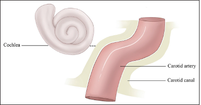 This figure demonstrates that the cochlea orientation in relation to the carotid canal and the closest distance between the cochlea and the carotid canal is 1.05 mm on average.