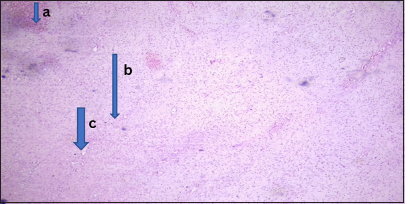 Benign lesion (myxoid fibroma). Photomicrograph of section from the nasal mass showing (a) pseudostratified columnar epithelium. (b) The stroma showed sheets of spindle-shaped cells, round-to-oval cells having bland nuclei with scanty cytoplasm and (c) few medium sized vascular channels. (Magnification: ×10 Hematoxylin and Eosin stain)