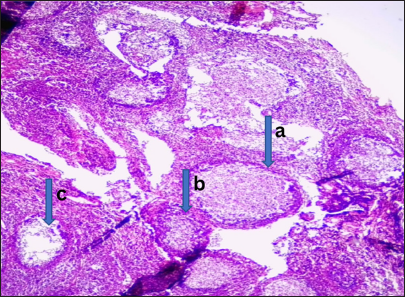 Malignant lesion (well-differentiated nasopharyngeal carcinoma). Photomicrograph: Section obtained from the nasal mass shows (a) a tumor disposed as irregular nests and anastomosing trabeculae. (b) The comprising cells have hyperchromatic to vesicular nuclei, prominent nucleoli, and indistinct cytoplasm. (c) The stroma is desmoplastic with extensive lymphocytic infiltrates. (Magnification: ×100 Hematoxylin and Eosin stain)