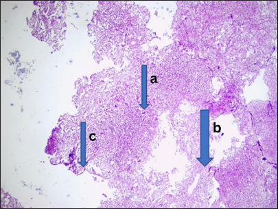 Infectious lesion (rhinomucormycosis). Photomicrograph of section from the fronto-ethnoidal tissue shows (a) several multinucleated giant cells, (b) several fungal hyphae and histiocytes. (c) These are disposed within fibrocollagenous stroma. Features were those of rhinomucormycosis. (Magnification: ×100 Hematoxylin and Eosin stain)