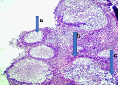 Keratinizing nasopharyngeal carcinoma. Photomicrograph: The nasopharyngeal tissue showed (a) a gamma disposed in a small nest and comprising of cells which are medically presumed to be large around nucleic, (b) prominent nucleic and moderate cytoplasm, it again showed individuals cells dyskeratosis. (c) These are disposed within a background of extensive inflammation and necrosis. (Magnification: ×100 Hematoxylin and Eosin stain)