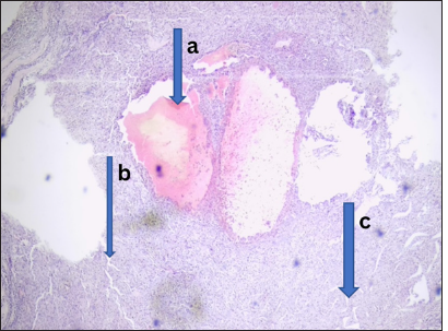 Metastatic papillary thyroid carcinoma. Photomicrograph of the sections from the cervical lymph node shows (a) infiltrating nests and sheets of discohesive clusters of atypical follicular epithelial cells. The cells exhibit marked pleomorphism having hyperchromatic nuclei and orphan Annie eye appearance. (b) Brisk mitosis was noted and few unremarkable variable sized colloid follicles were seen. (c) The accompanying lymph node demonstrates similar atypical follicular cells. (Magnification: × 40 Hematoxylin and Eosin stain)