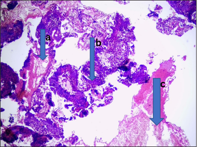 Plasmacytoma. Photomicrograph from the cervical lymph nodes shows, (a) dense monotonous infiltrates of plasma cells ranging from mature binucleated to anaplastic with effaced nodal architecture. (b) These were traversed by collagenous trabeculae. (c) Numerous eosinophilic globules were seen, suggestive of Russell bodies. (Magnification: ×100 Hematoxylin and Eosin stain)