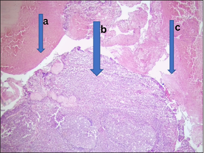 Received lymphoid hyperplasia. Photomicrograph of section from the adenoids shows (a) hyperplastic lymphoid follicles with (b) prominent germinal center in addition to (c) extensive areas of hemorrhage. (Magnification: ×100 Hematoxylin and Eosin stain)