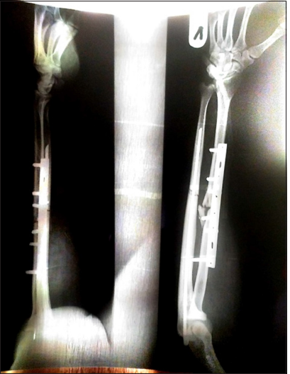 Post-operative X-ray (plate and screw).