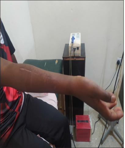 Active pronation after 24th sessions.