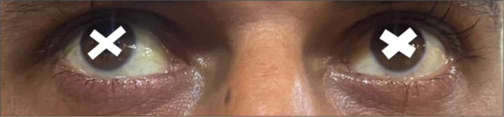 Resolution of jaundice 6 weeks after starting phenobarbitone therapy.