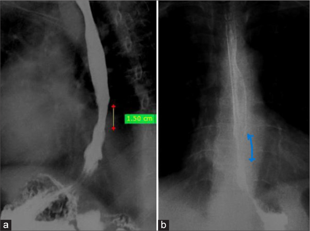 (a) Red dots and yellow line shows Stricture (b) Blue line denotes short segment stricture.