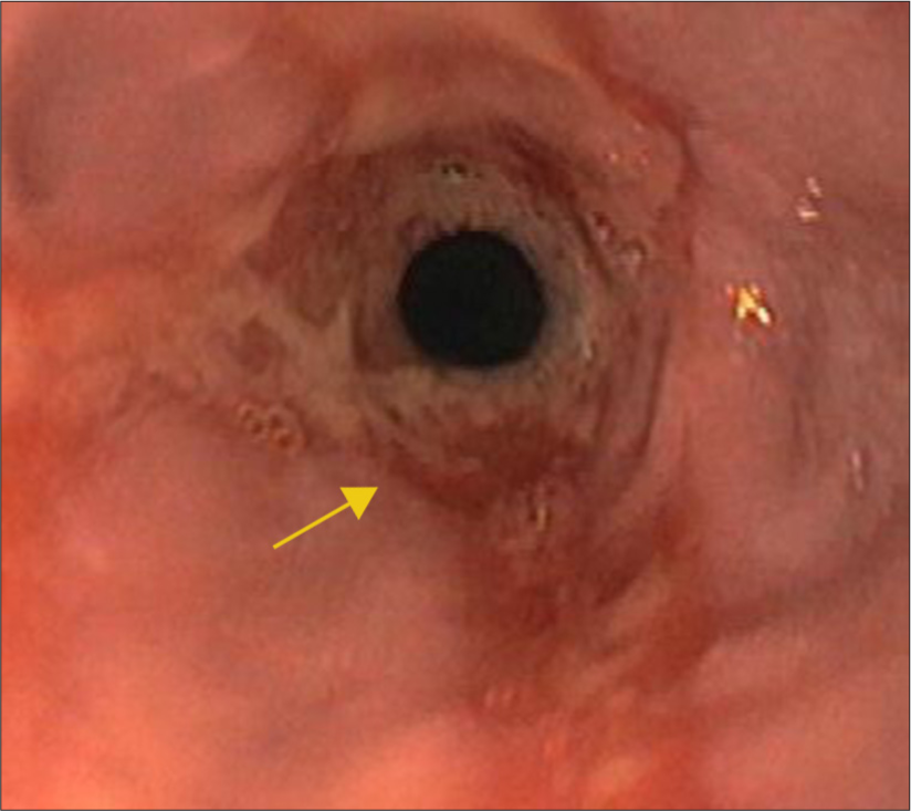 Pre-management endoscopy image confirming stricture with ulcerated mucosa denoted by yellow arrow.