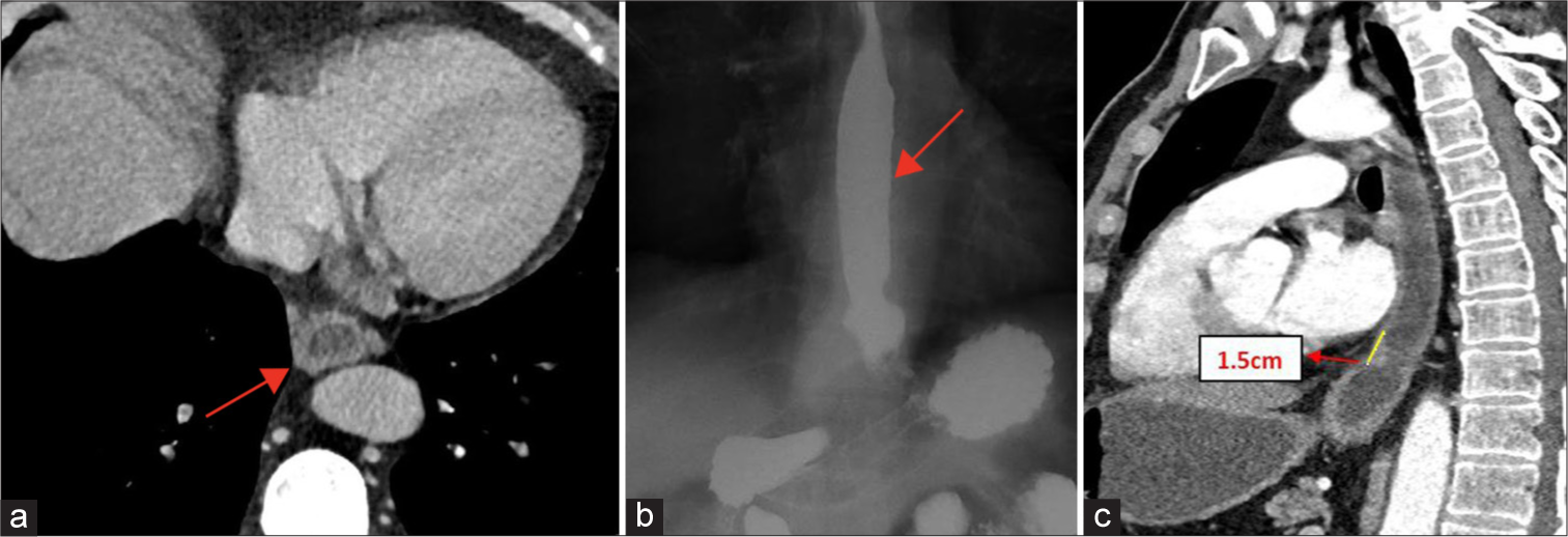 (a) Post-management computed tomography (CT). Axial section showing reduced esophageal wall thickness (5 mm) (red arrow). (b) Post-management barium swallow Antero-posterior (AP) view showing no stricture, however hiatus hernia was seen as denoted by red arrow. (c) Post-management CT sagittal oblique views showing reduced length of stricture to 1.5 cm with minimal luminal narrowing denoted by yellow line.